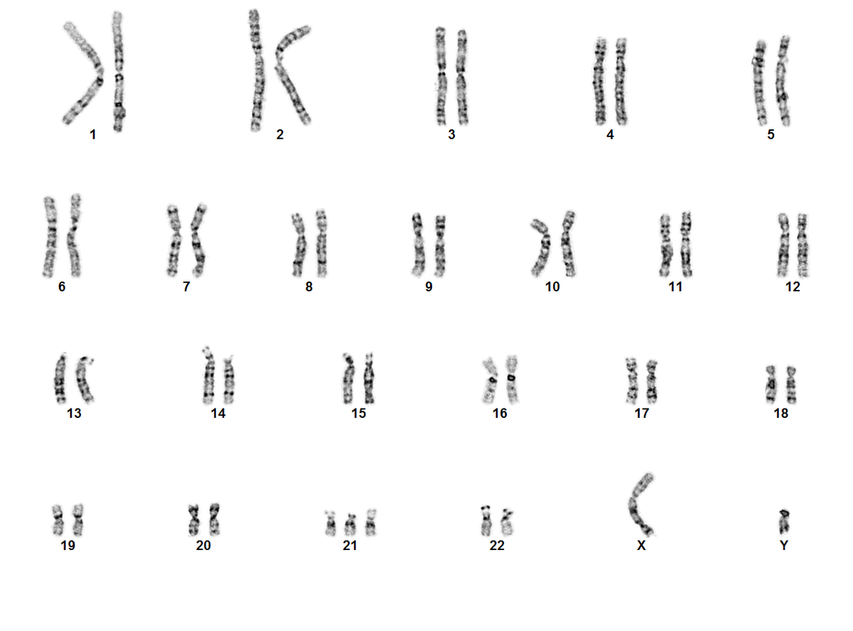 Trisomi 21