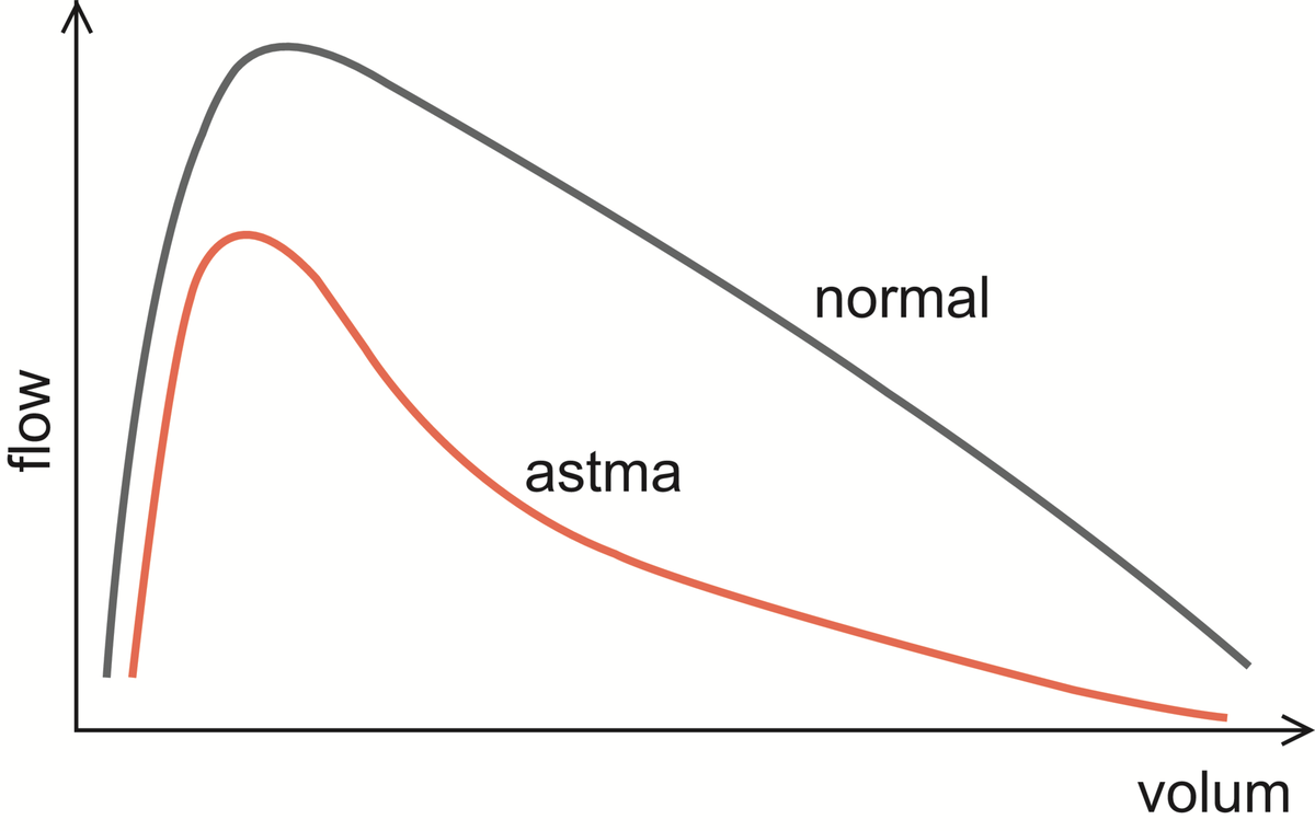 astma