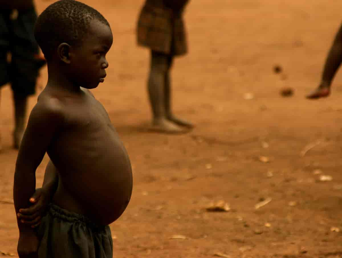 Kwashiorkor