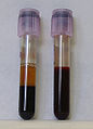 Deutsch: Blutproben English: Blood samples Español: Muestras de sangre Română: Mostre de sânge Italiano: Campioni di sangue