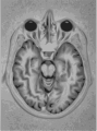 illustration of MRI scan