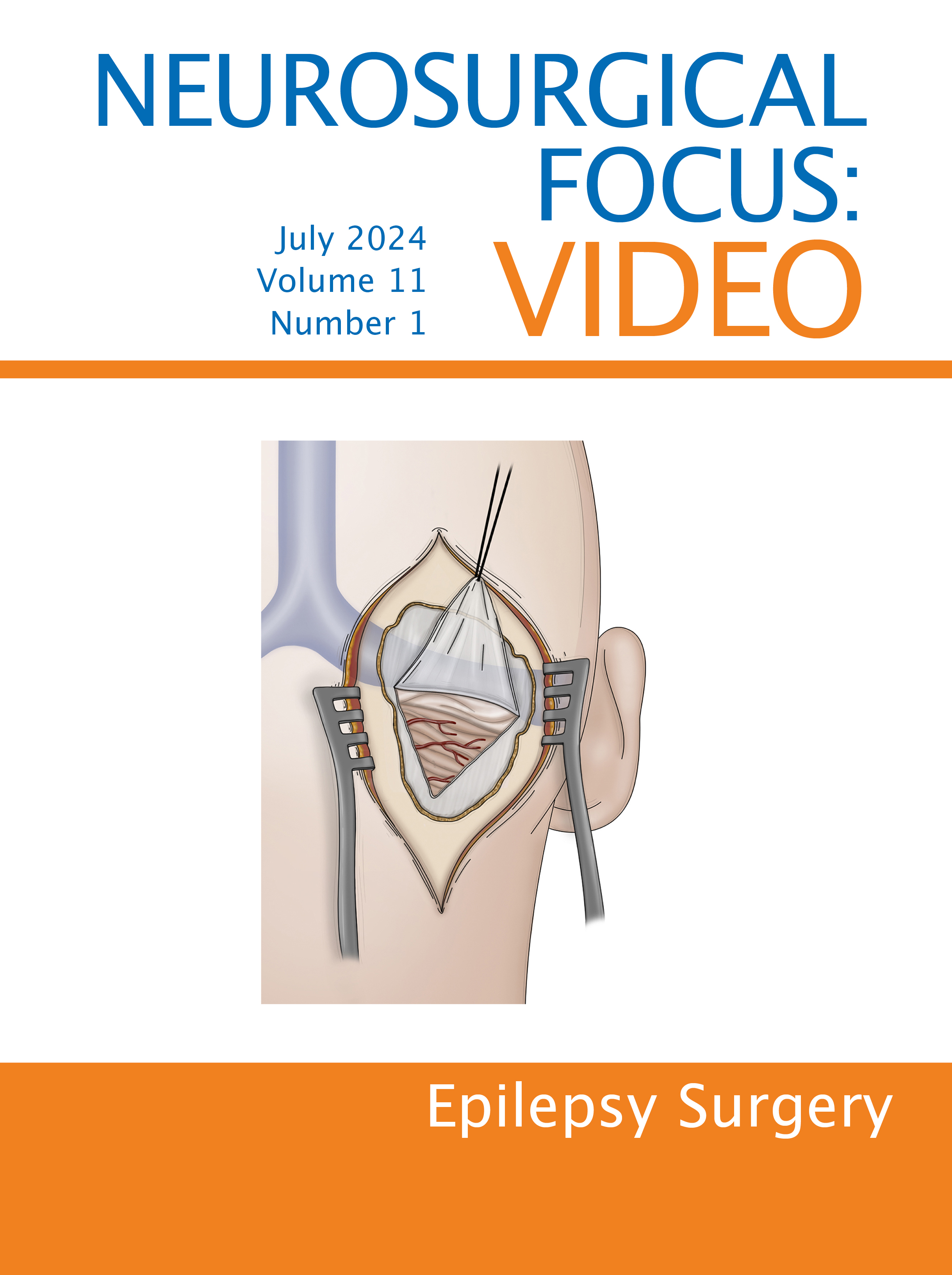 Volume 11: Issue 1 (July 2024): Epilepsy Surgery